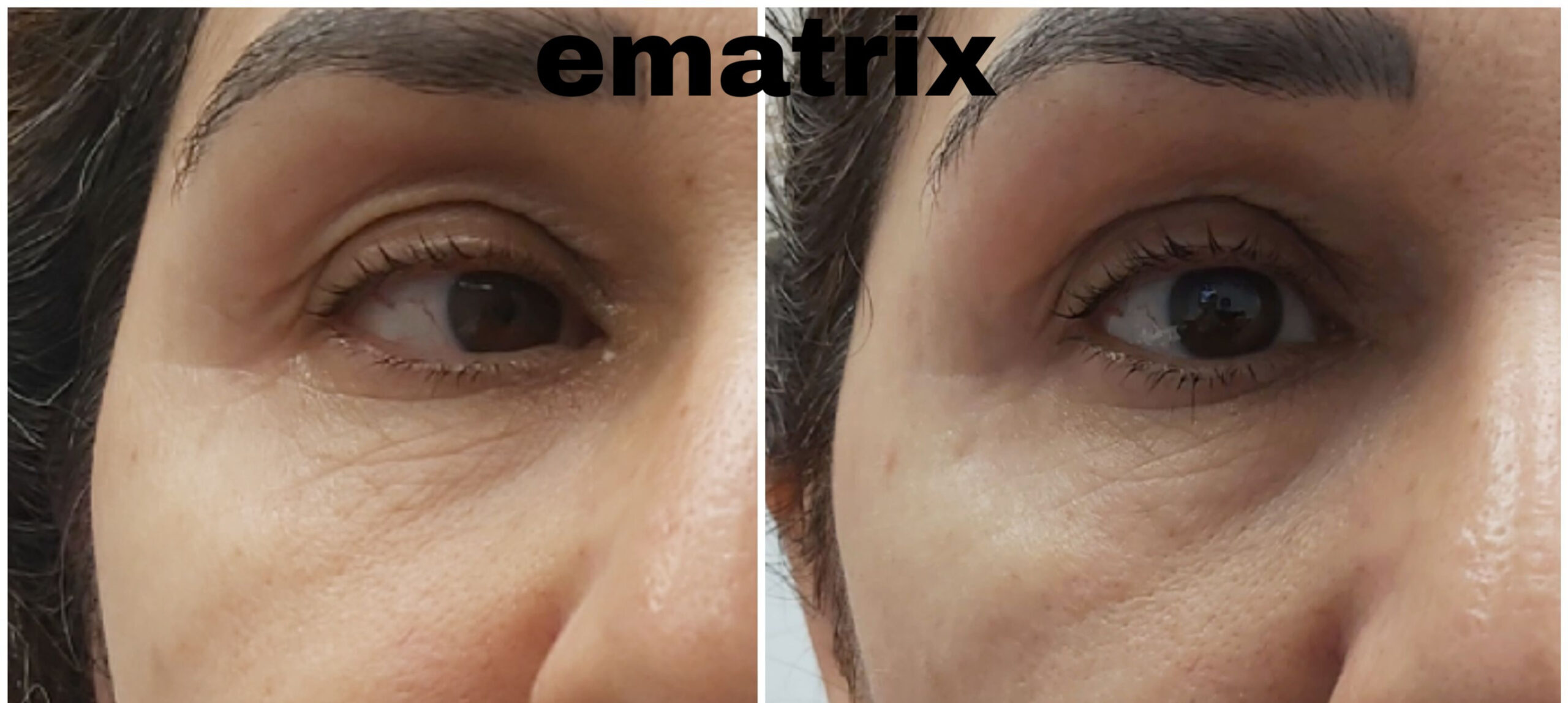 droopy eyes timeless med spa scaled
