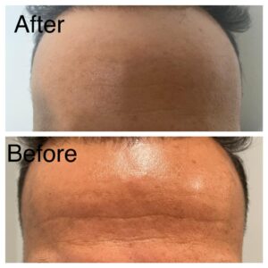 Micro needling Results 1