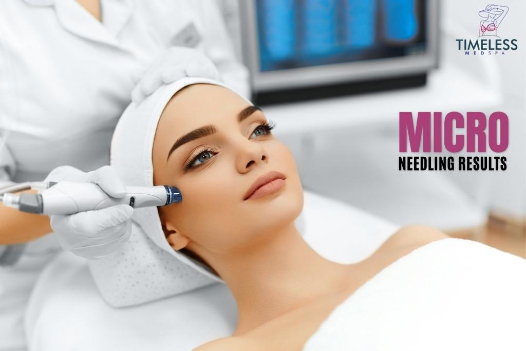 Micro Needling Results